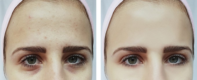 filler-occhiaie-prima-dopo